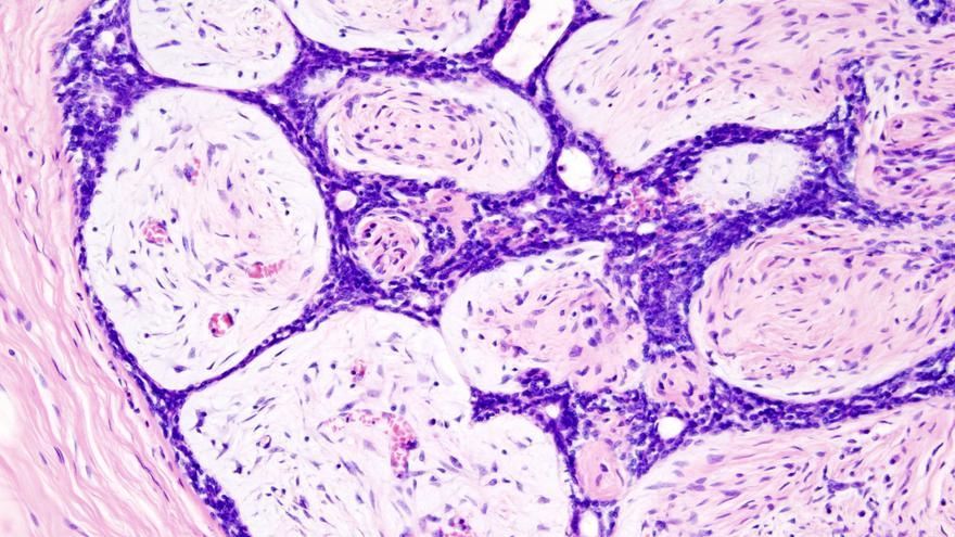 Imagen microscópica de la biopsia de un cáncer de mama. (CC)