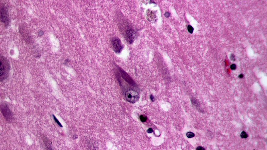 Ovillos neurofibrilares en el hipocampo de una persona anciana con alzhéimer. (Wikipedia)