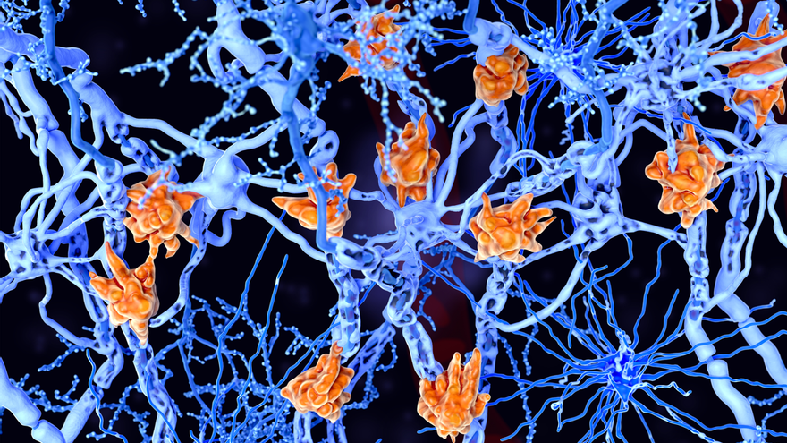 En la esclerosis múltiple, las células de la microglía dañan la vaina de mielina de los axones de las neuronas. (Adobe Stock/Sinc)