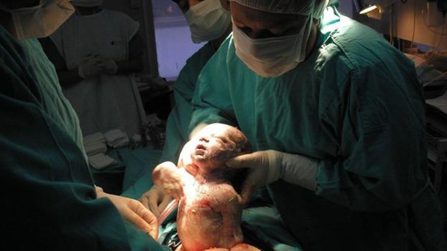 La cesárea es una operación y trae consigo posibilidades de hemorragia posparto. (Wikimedia)