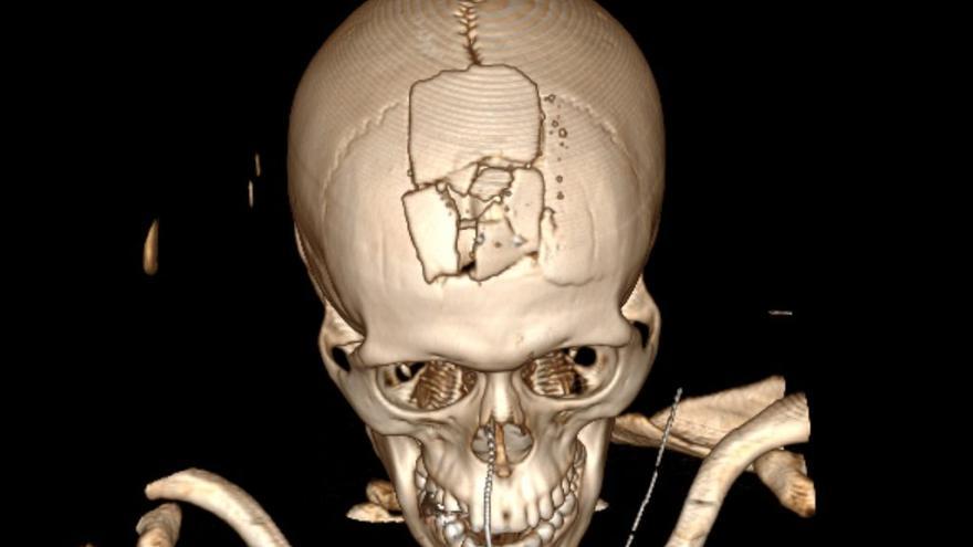 La tomografía de José Alfredo Urroz muestra uno de los disparos más letales entre las víctimas. La bala estalló toda la parte frontal del cráneo al salir.