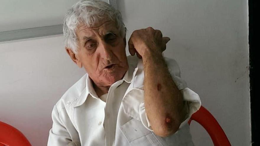 Alfredo Guilleuma Rodríguez, el viejo Alfredo, mostrando las heridas de un acto represivo. (Facebook)
